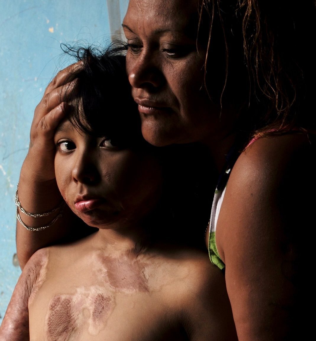 A mother hugs her child with visible burns on the chest and arms.